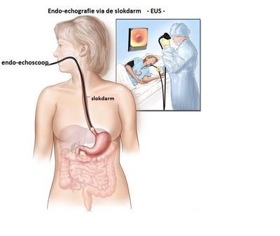 Endo-echografie